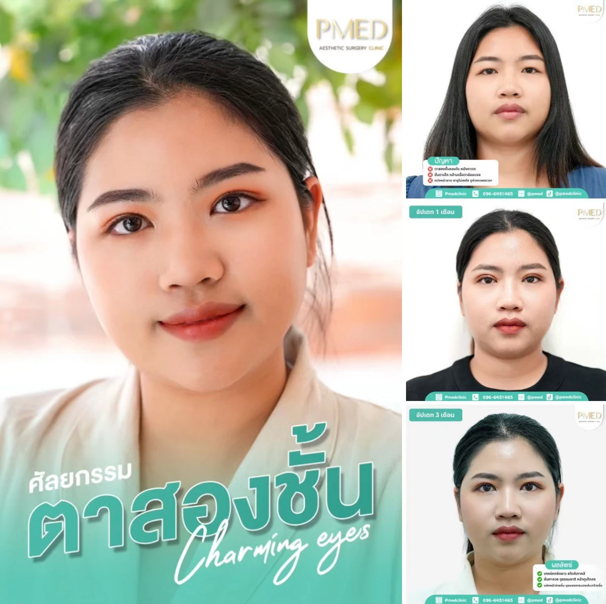 LINE_ALBUM_ตาสองชั้น 👁️_260715_23
