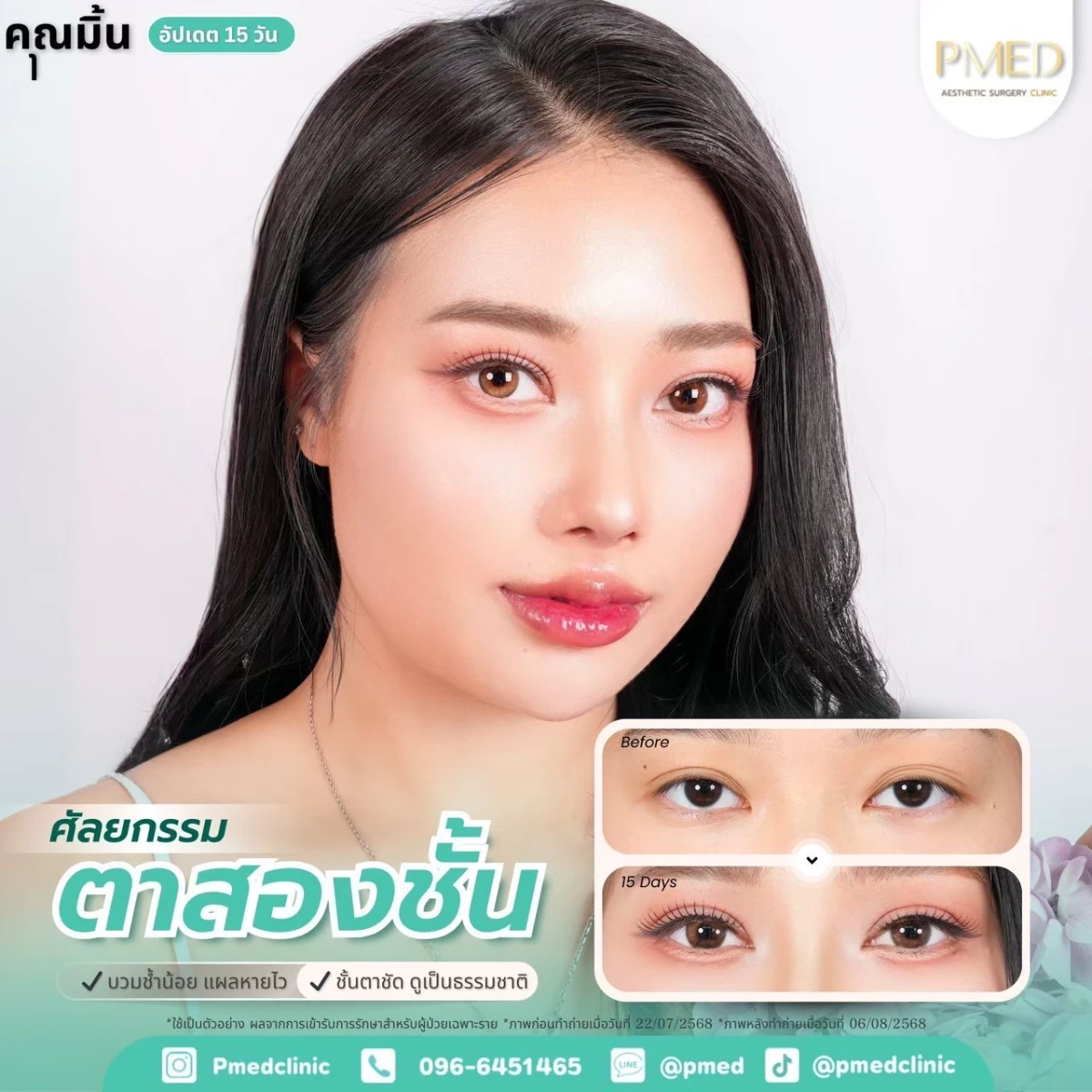 LINE_ALBUM_ตาสองชั้น 👁️_260715_8