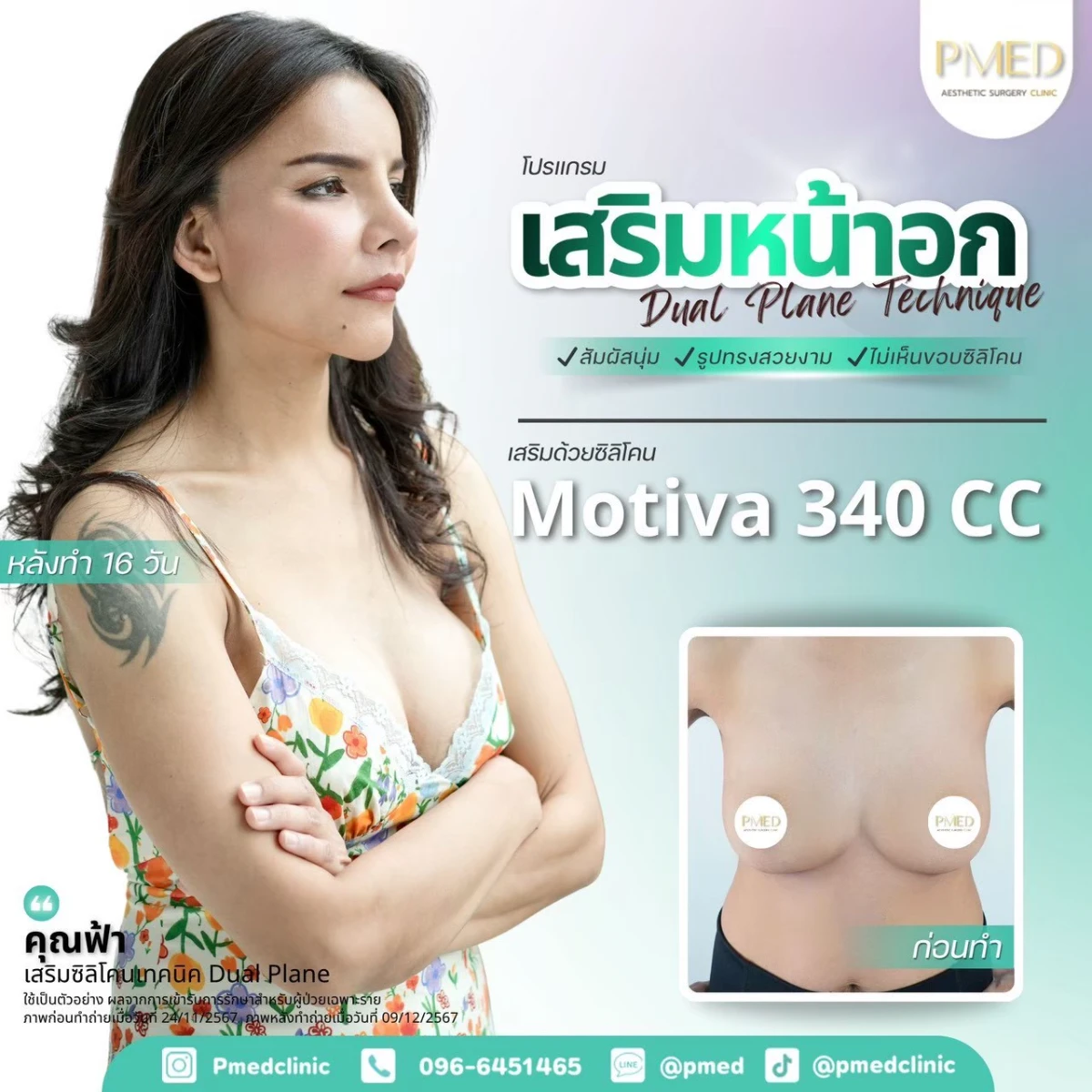LINE_ALBUM_เสริมหน้าอก 🍼_260715_2