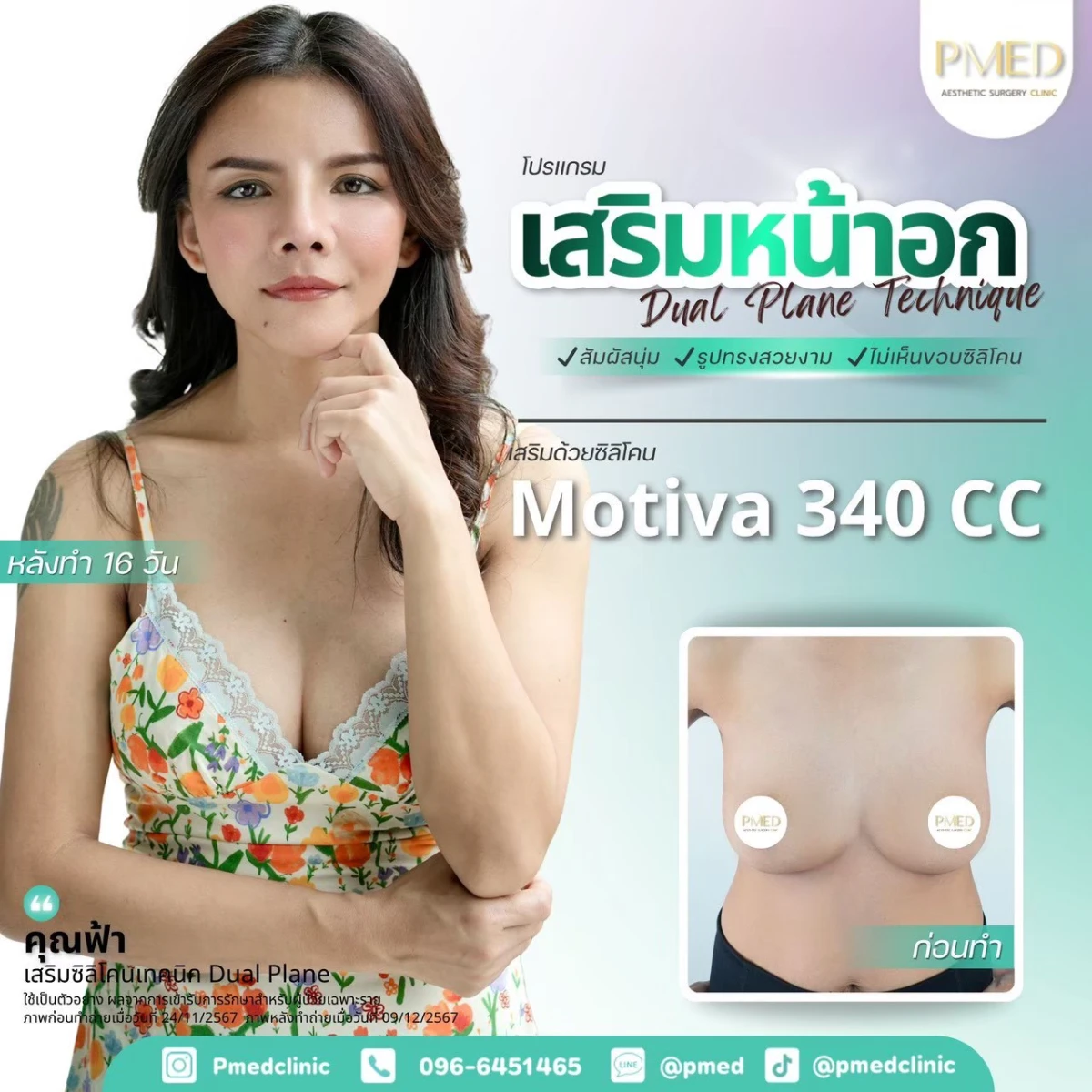 LINE_ALBUM_เสริมหน้าอก 🍼_260715_3