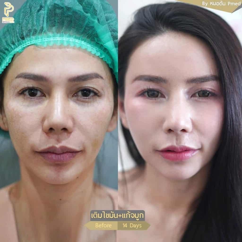 เจาะลึกไทม์ไลน์การฟื้นตัวหลังฉีดไขมันหน้าผาก ต้องใช้เวลากี่วันถึงเข้าที่? กี่เดือนถึงเห็นผล?