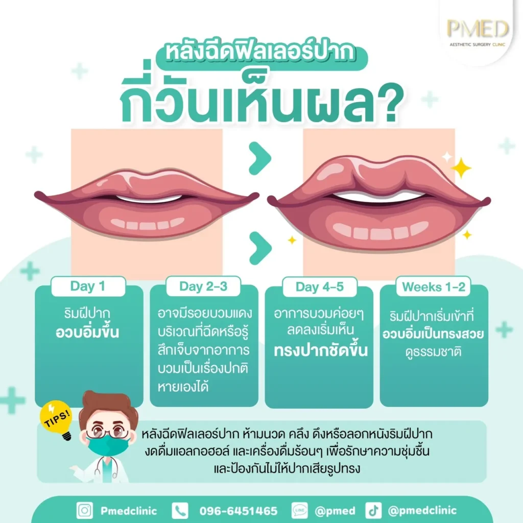ปัญหาการฉีดฟิลเลอร์แล้วเป็นก้อน พร้อมตำแหน่งที่พบบ่อย