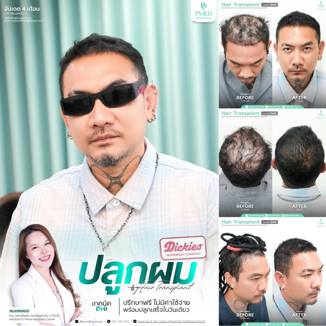 ปลูกผม (1080 x 1080 px) (13)