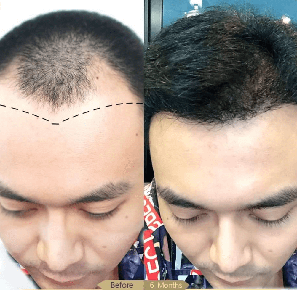 กราฟต์ผมคืออะไร? ฟื้นฟูเส้นผมอย่างเป็นธรรมชาติด้วยการปลูกผมถาวร