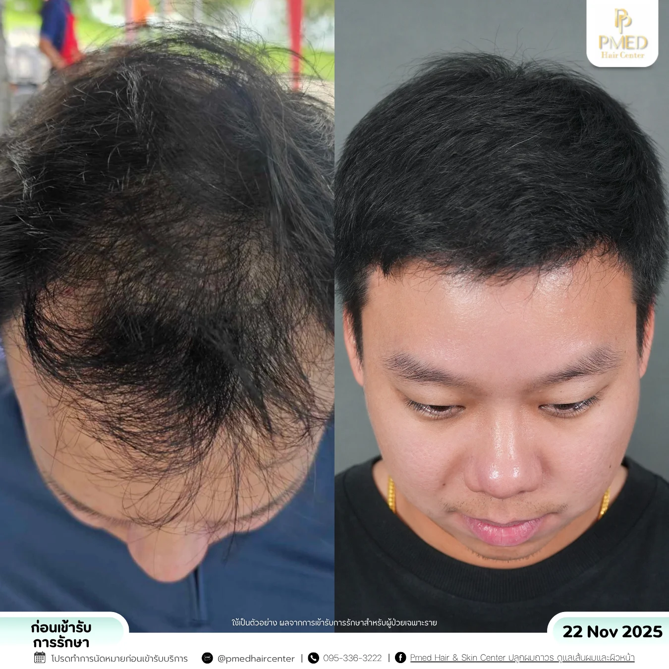 รีวิวPRP-10