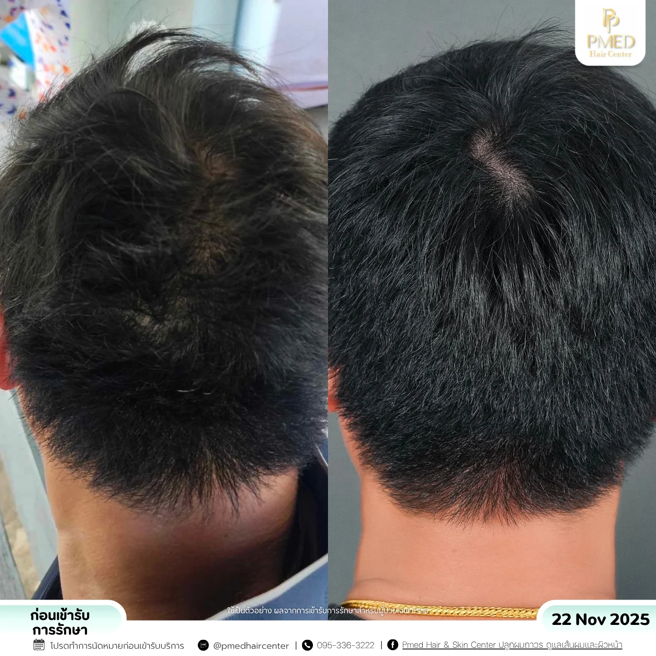 รีวิวPRP-8
