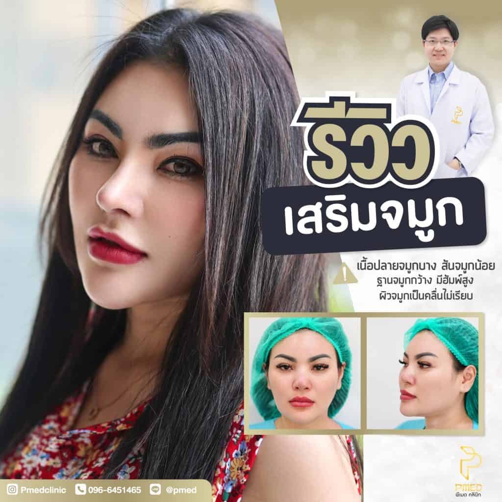 ข้อดีของการเสริมจมูกแบบโอเพ่น เทคนิคที่ให้ผลลัพธ์แม่นยำและเป็นธรรมชาติ