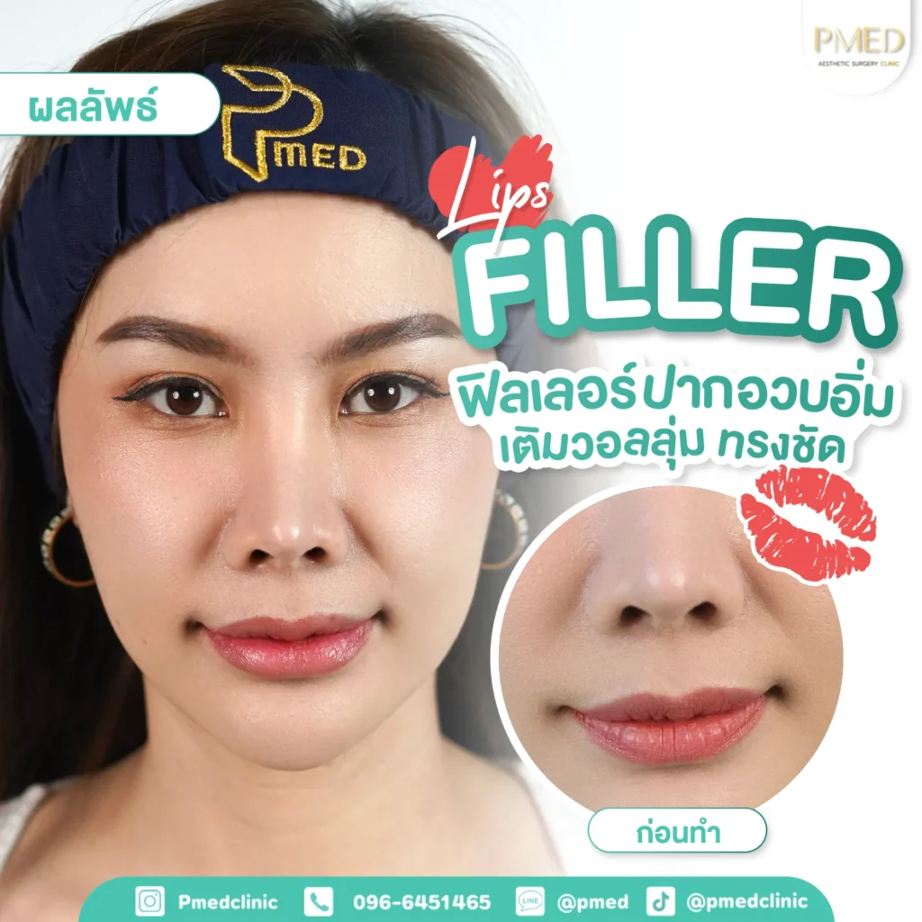 วิธีตรวจสอบฟิลเลอร์แท้ และการแก้ปัญหาฟิลเลอร์เป็นก้อน