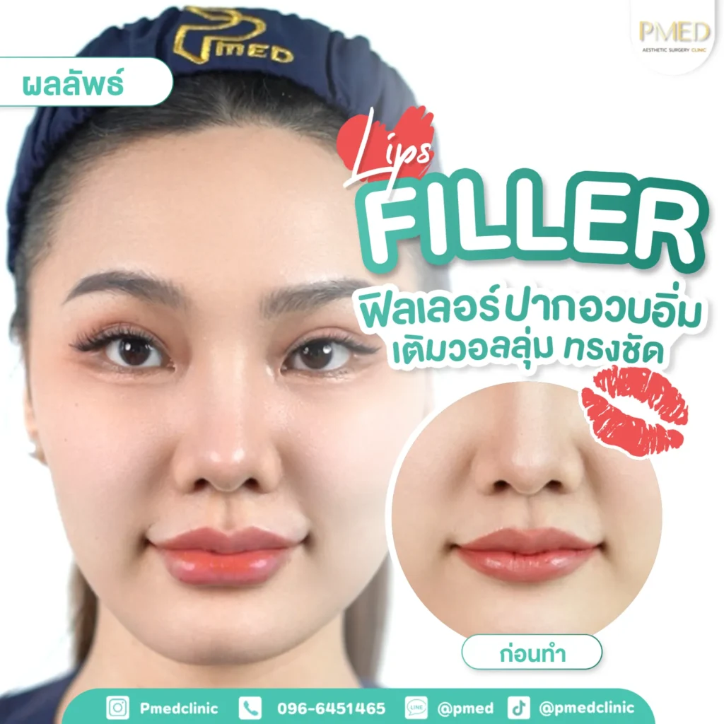 ปัญหาการฉีดฟิลเลอร์แล้วเป็นก้อน พร้อมตำแหน่งที่พบบ่อย