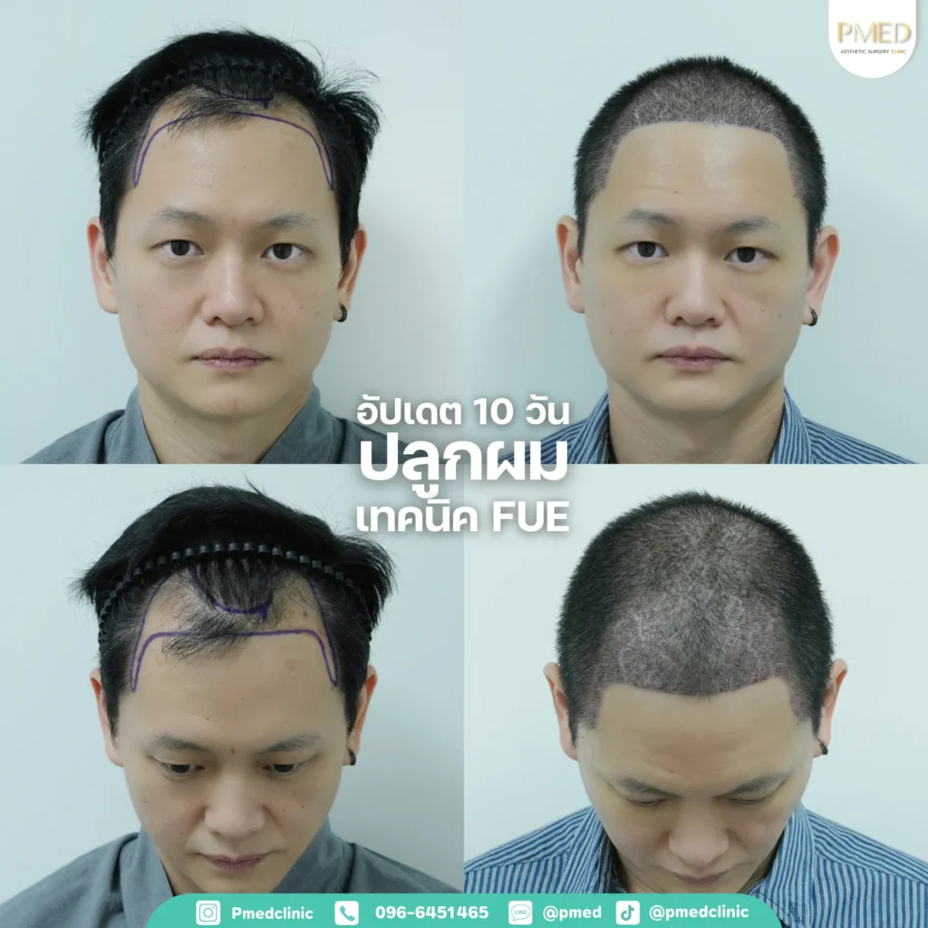 การปลูกผมคืออะไร? คู่มือฉบับเต็มสำหรับผู้มีปัญหาผมบาง ศีรษะล้าน