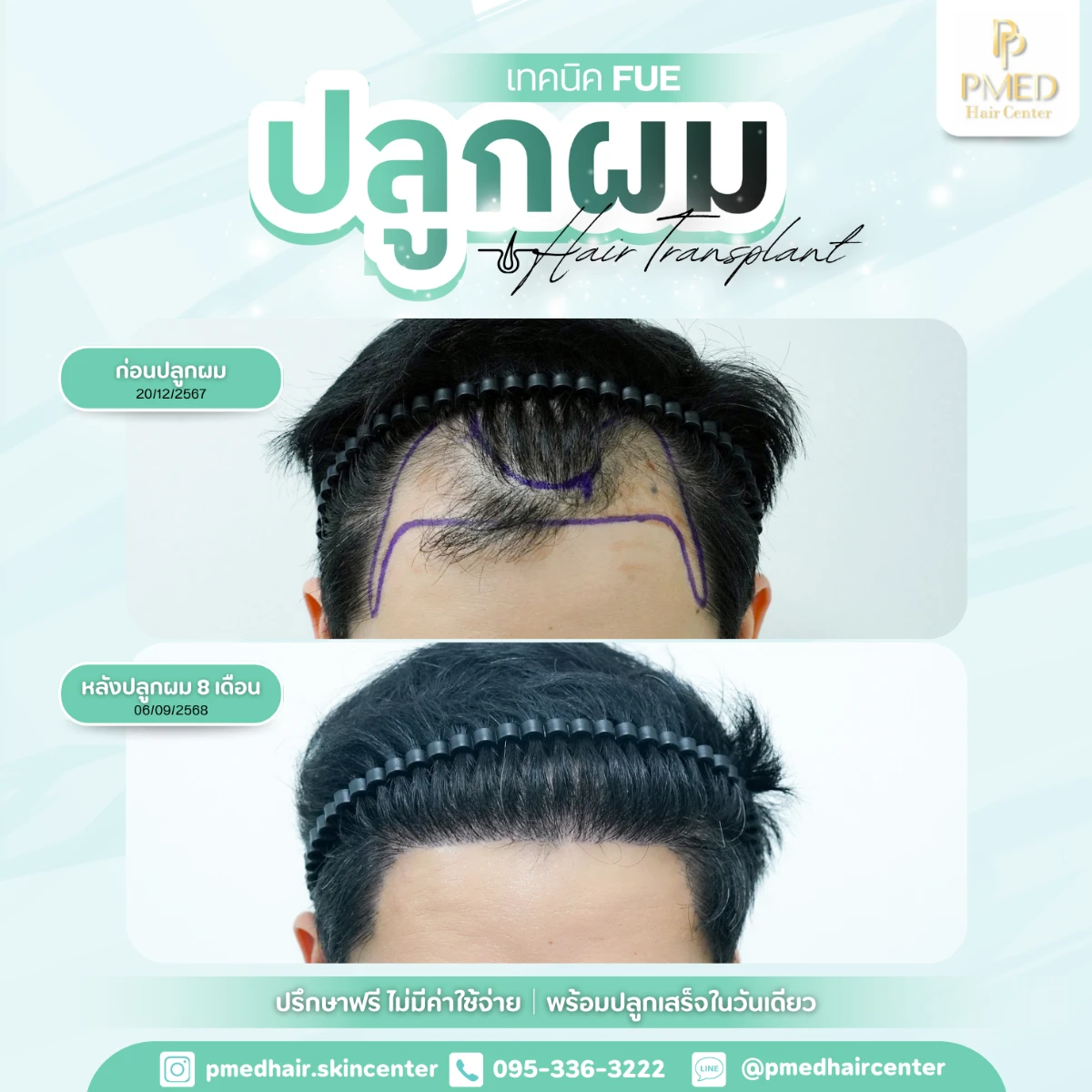 เทคนิค FUE (18)
