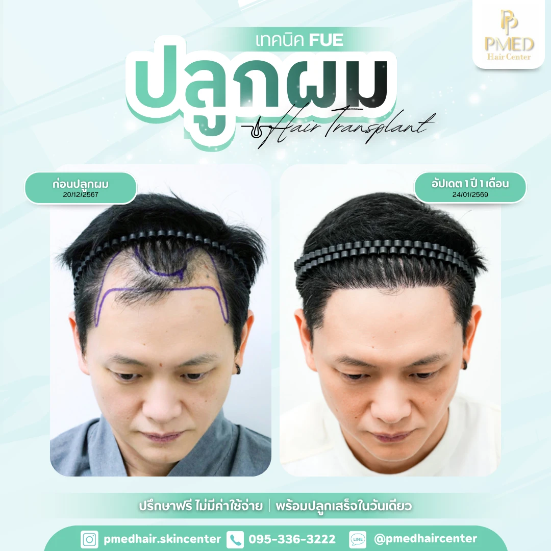 เทคนิค FUE (19)