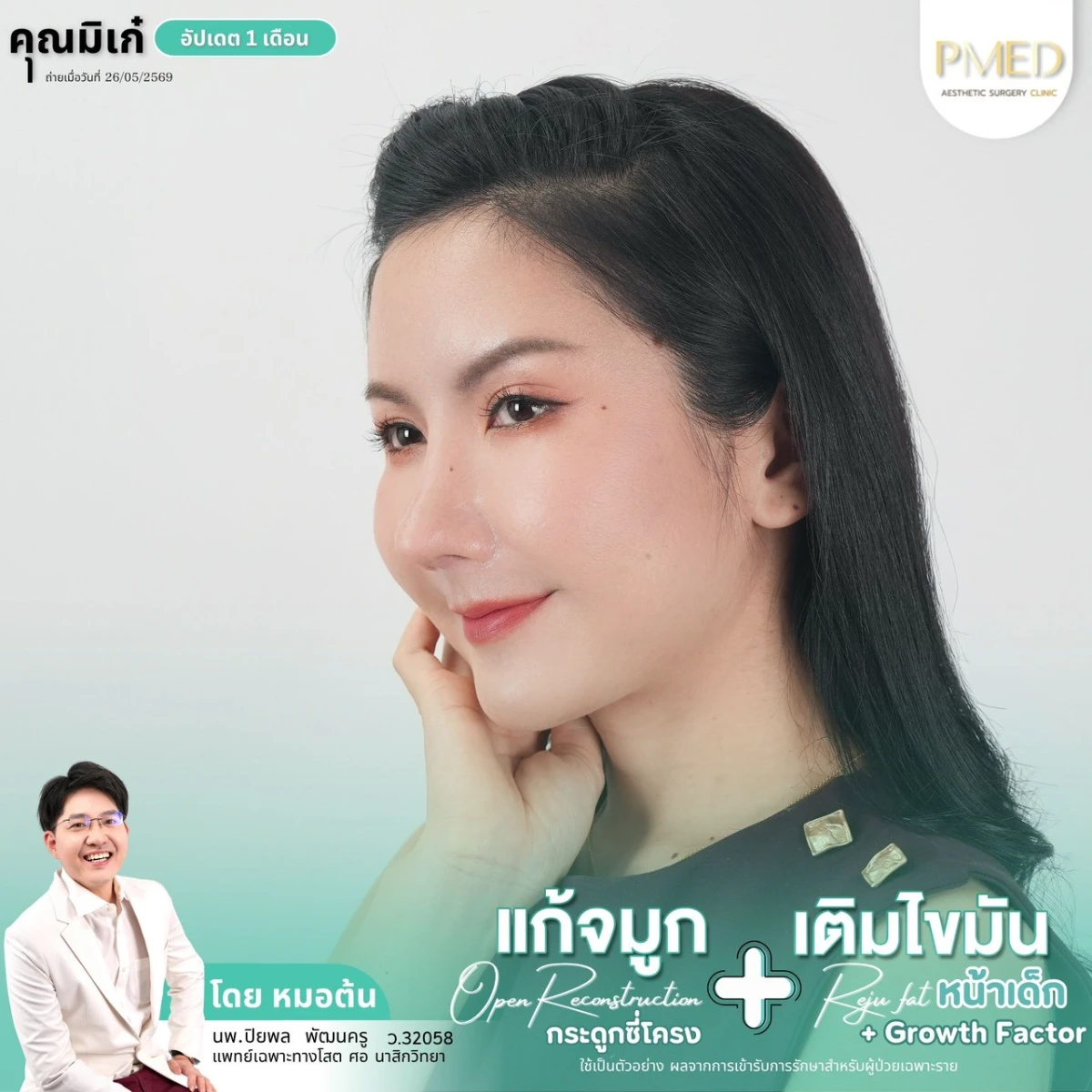 LINE_ALBUM_จมูก + ไขมัน 👃🏻👧🏻_260716_13