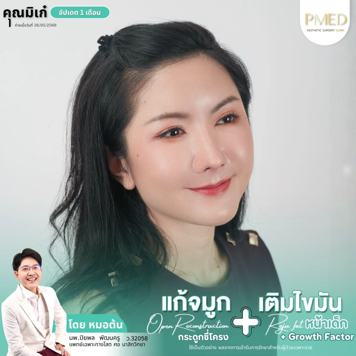 LINE_ALBUM_จมูก + ไขมัน 👃🏻👧🏻_260716_14