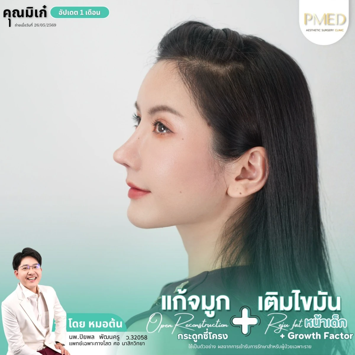LINE_ALBUM_จมูก + ไขมัน 👃🏻👧🏻_260716_15
