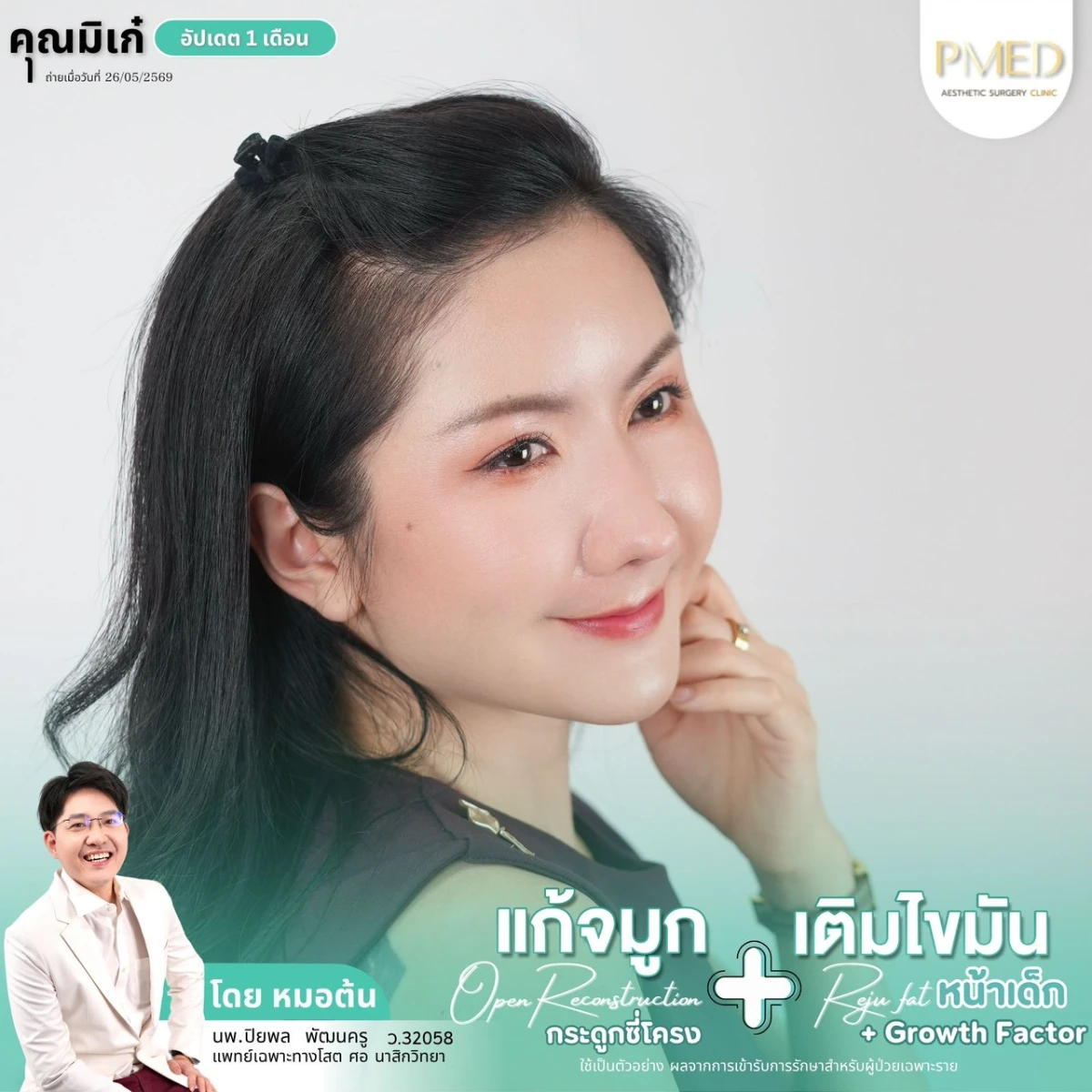 LINE_ALBUM_จมูก + ไขมัน 👃🏻👧🏻_260716_16