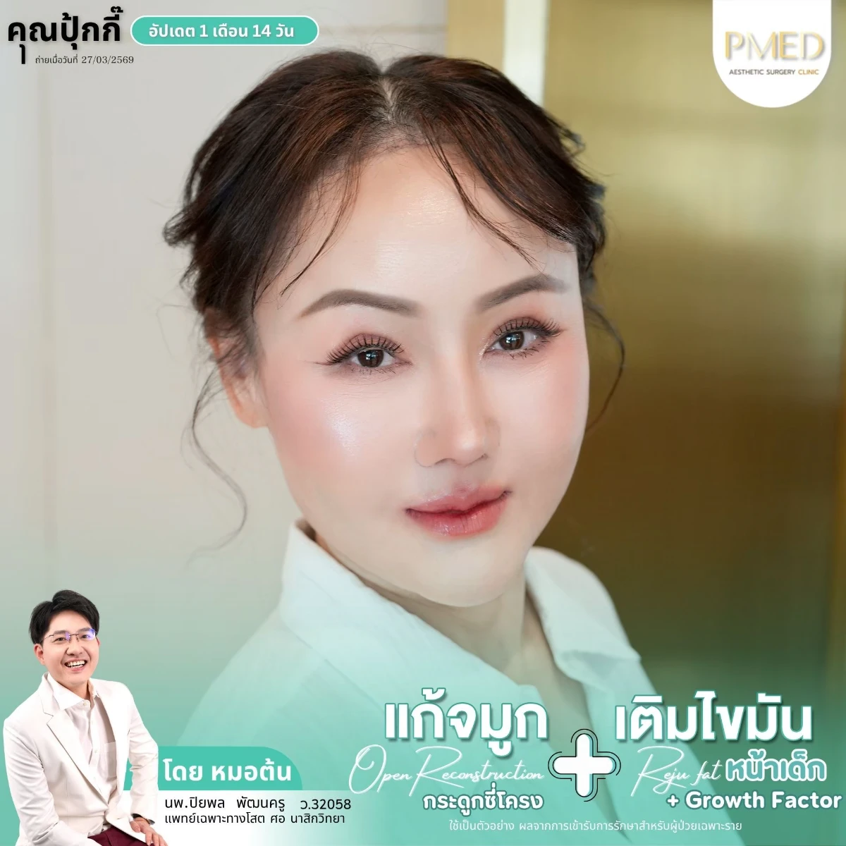 LINE_ALBUM_จมูก + ไขมัน 👃🏻👧🏻_260716_26
