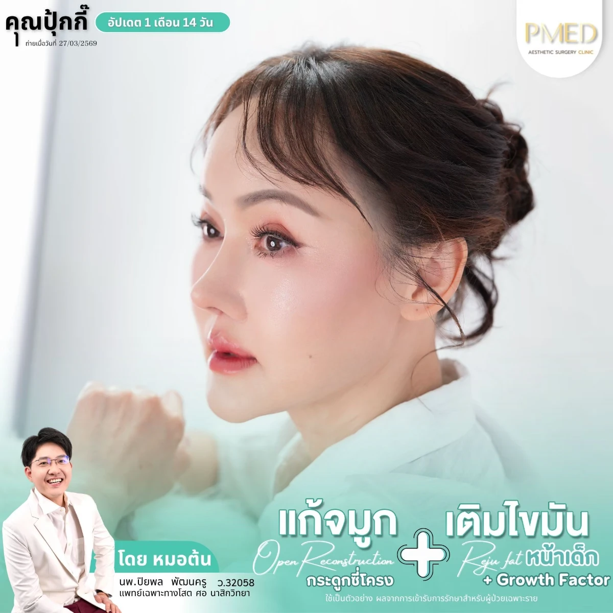 LINE_ALBUM_จมูก + ไขมัน 👃🏻👧🏻_260716_27