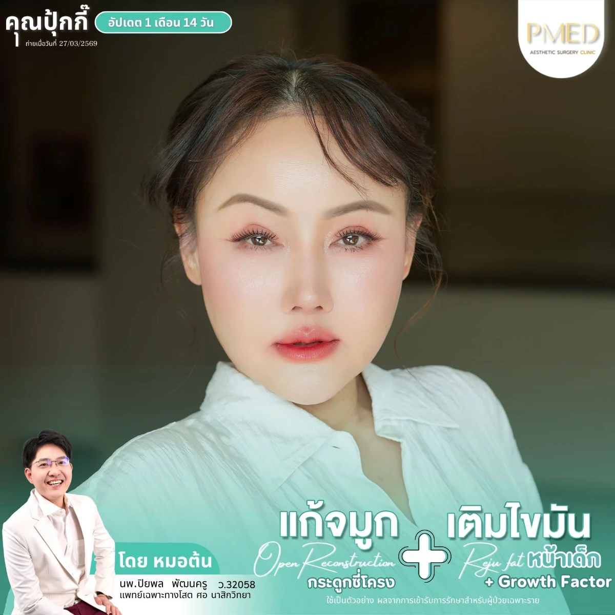LINE_ALBUM_จมูก + ไขมัน 👃🏻👧🏻_260716_28