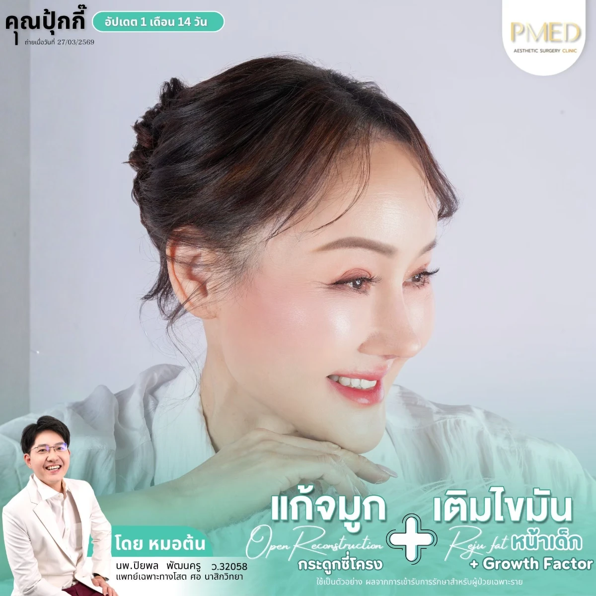LINE_ALBUM_จมูก + ไขมัน 👃🏻👧🏻_260716_29