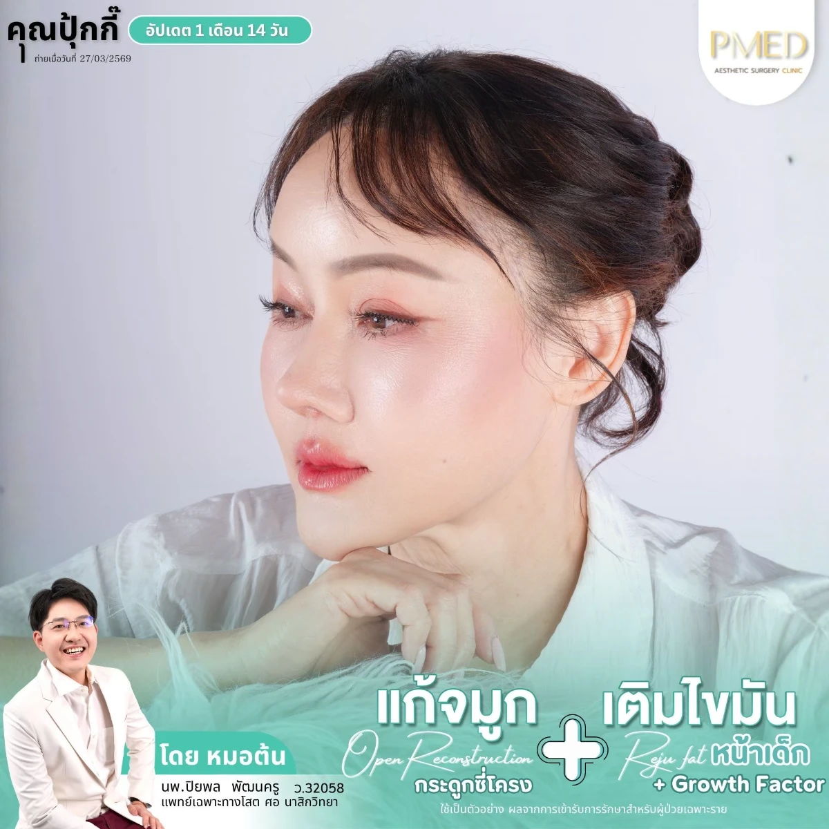 LINE_ALBUM_จมูก + ไขมัน 👃🏻👧🏻_260716_30
