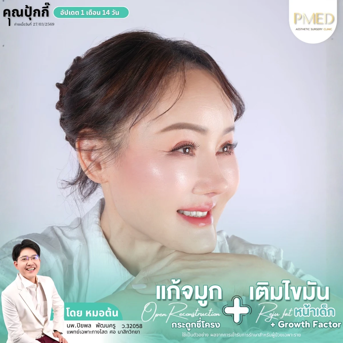 LINE_ALBUM_จมูก + ไขมัน 👃🏻👧🏻_260716_31