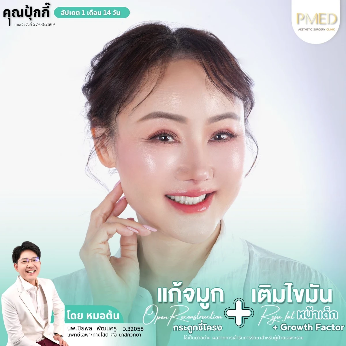 LINE_ALBUM_จมูก + ไขมัน 👃🏻👧🏻_260716_32