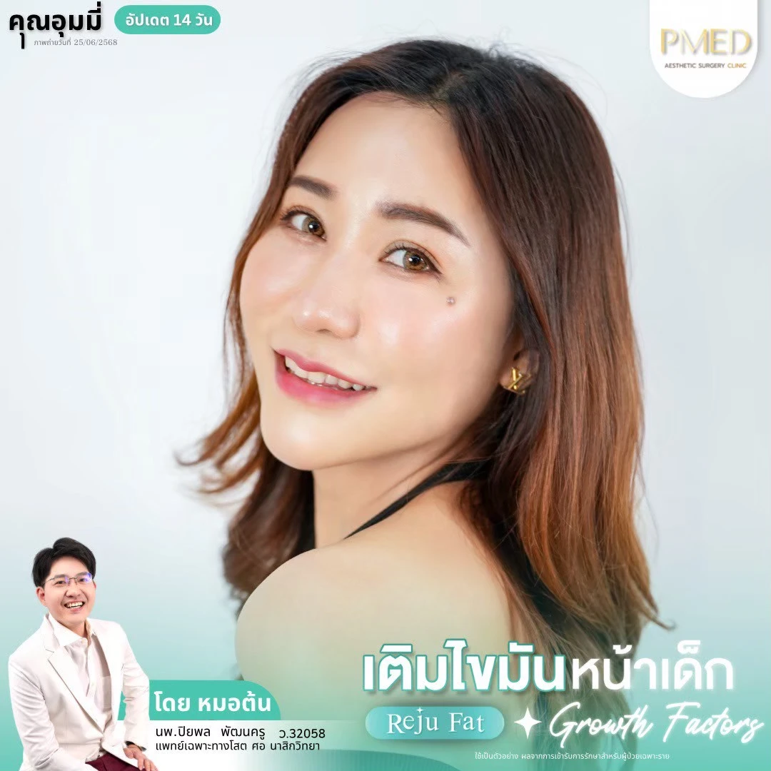 LINE_ALBUM_เติมไขมัน Reju Fat ✨_260715_70