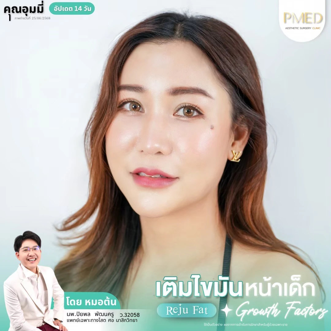 LINE_ALBUM_เติมไขมัน Reju Fat ✨_260715_71