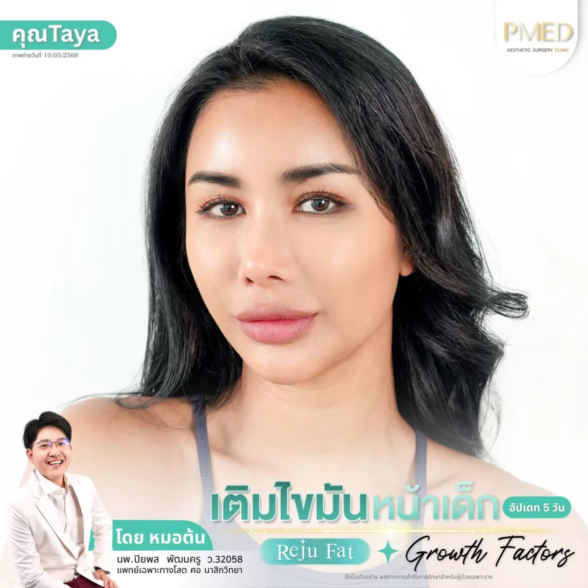 LINE_ALBUM_เติมไขมัน Reju Fat ✨_260715_74