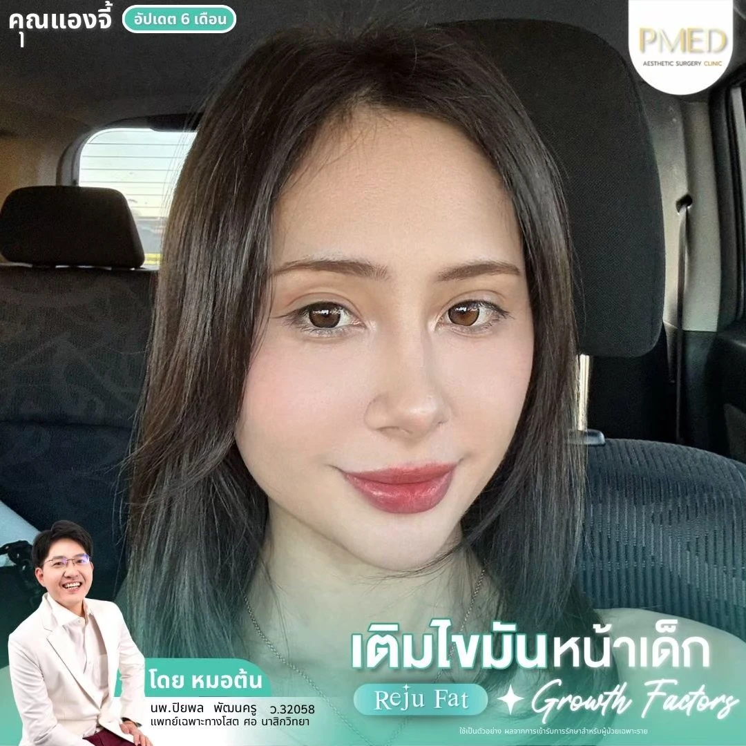 LINE_ALBUM_เติมไขมัน Reju Fat ✨_260715_8