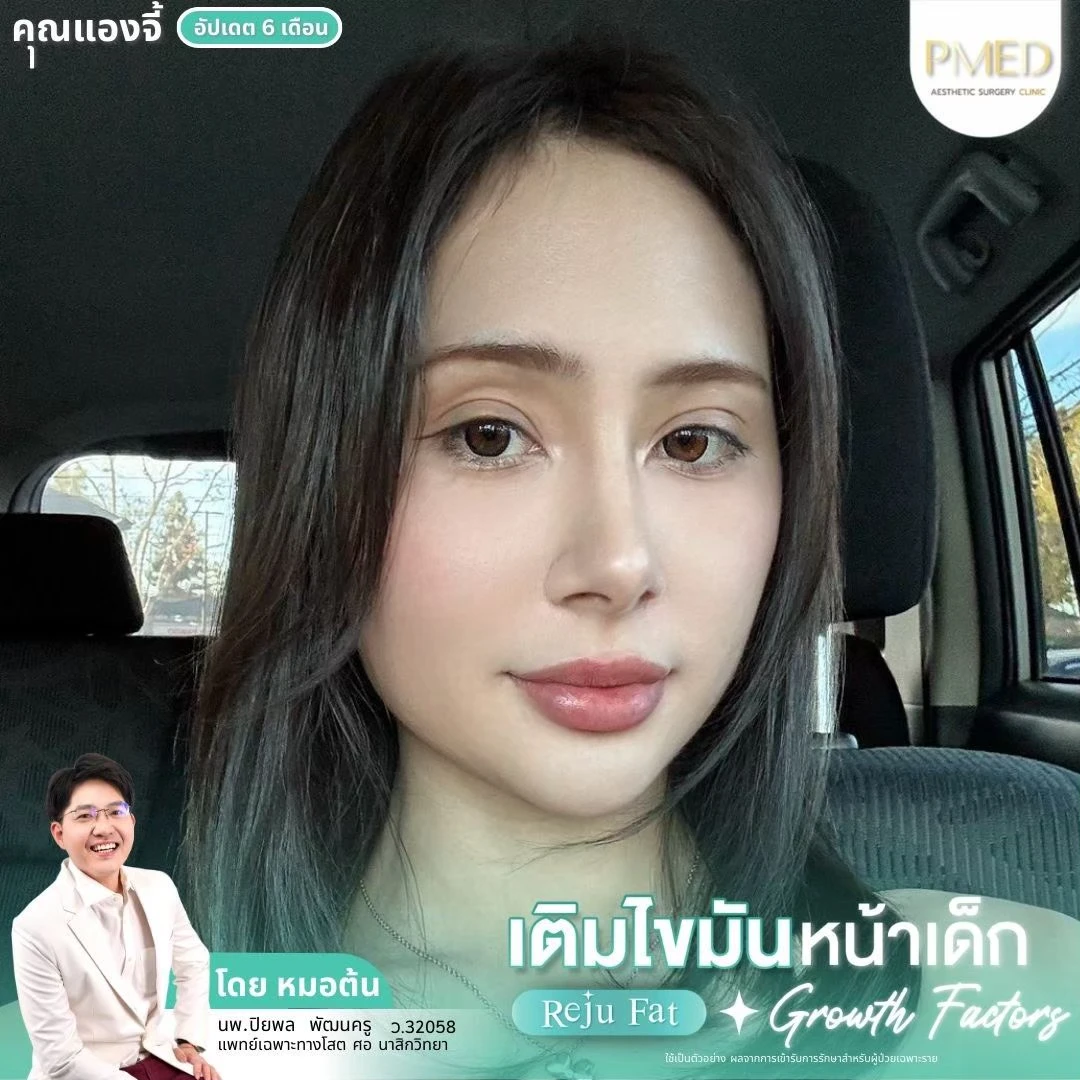 LINE_ALBUM_เติมไขมัน Reju Fat ✨_260715_9