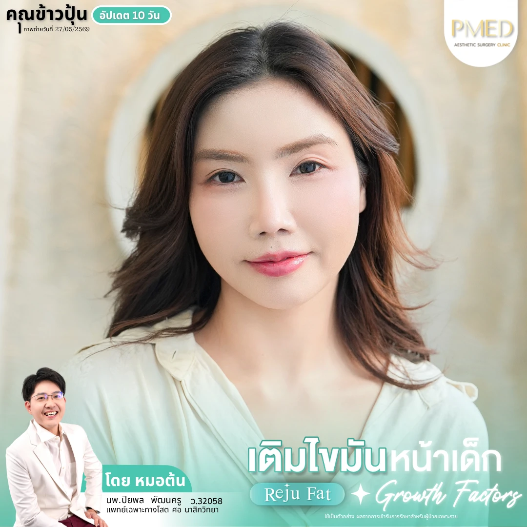 เติมไขมัน (12)