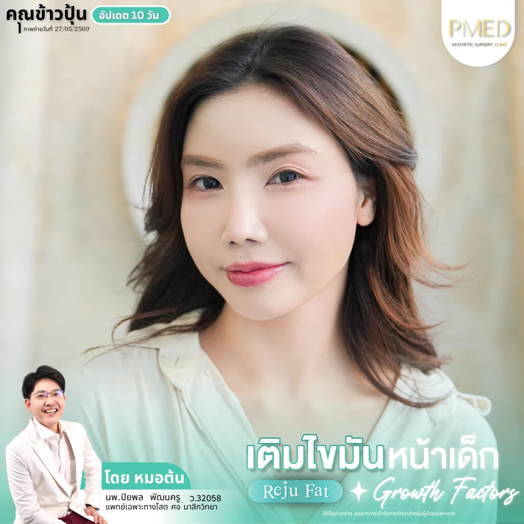 เติมไขมัน (9)