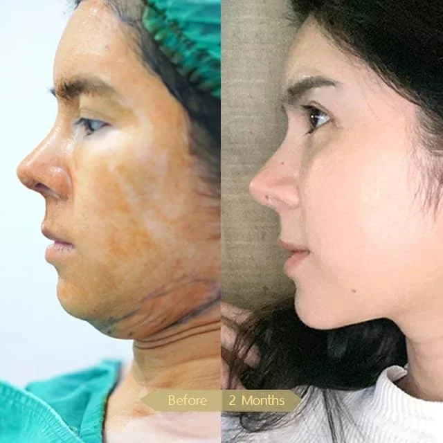 Liposuction-00011