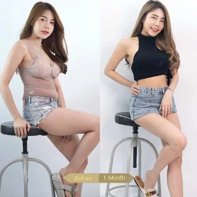 Liposuction-00012