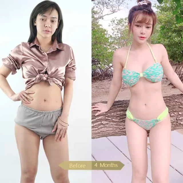 Liposuction-00013