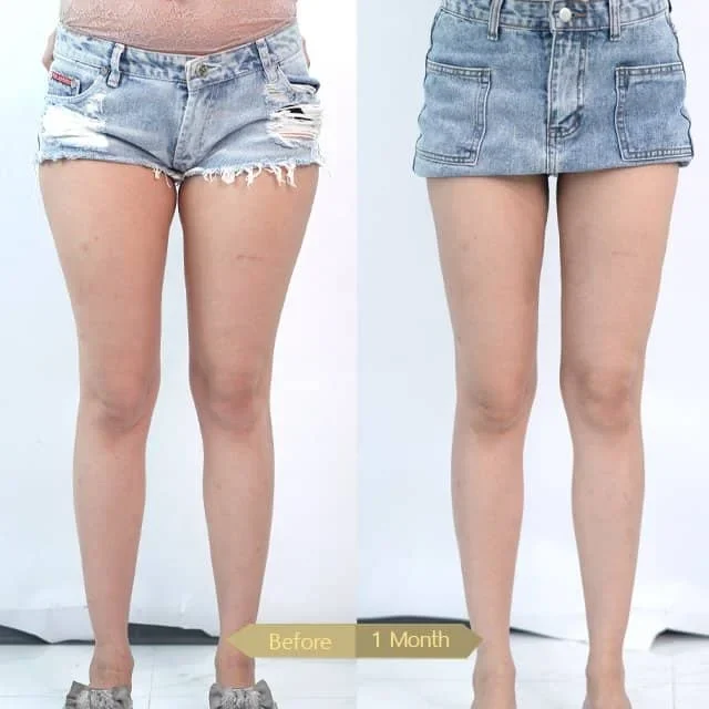 Liposuction-00014